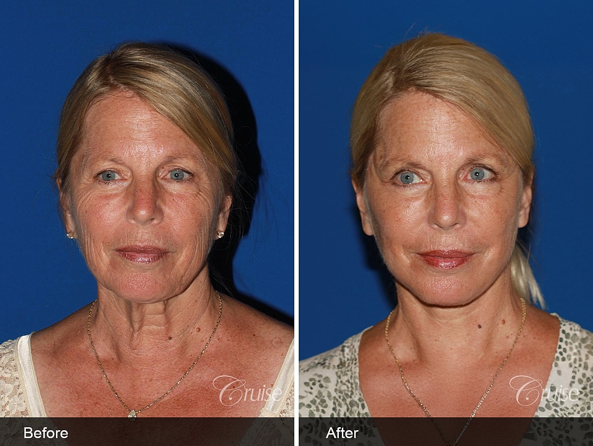 facelift before and after