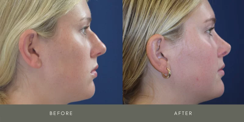 rhinoplasty before & after