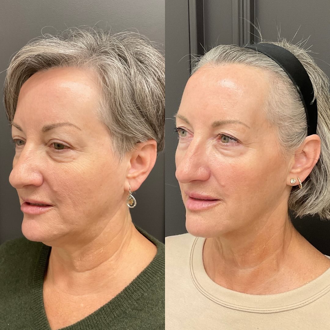 rf microneedling patient 2 before and after