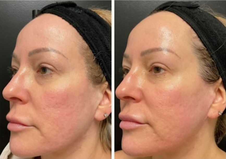 Microneedling patient before & after
