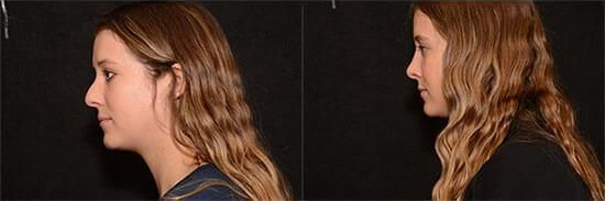 rhinoplasty before and after patient 4