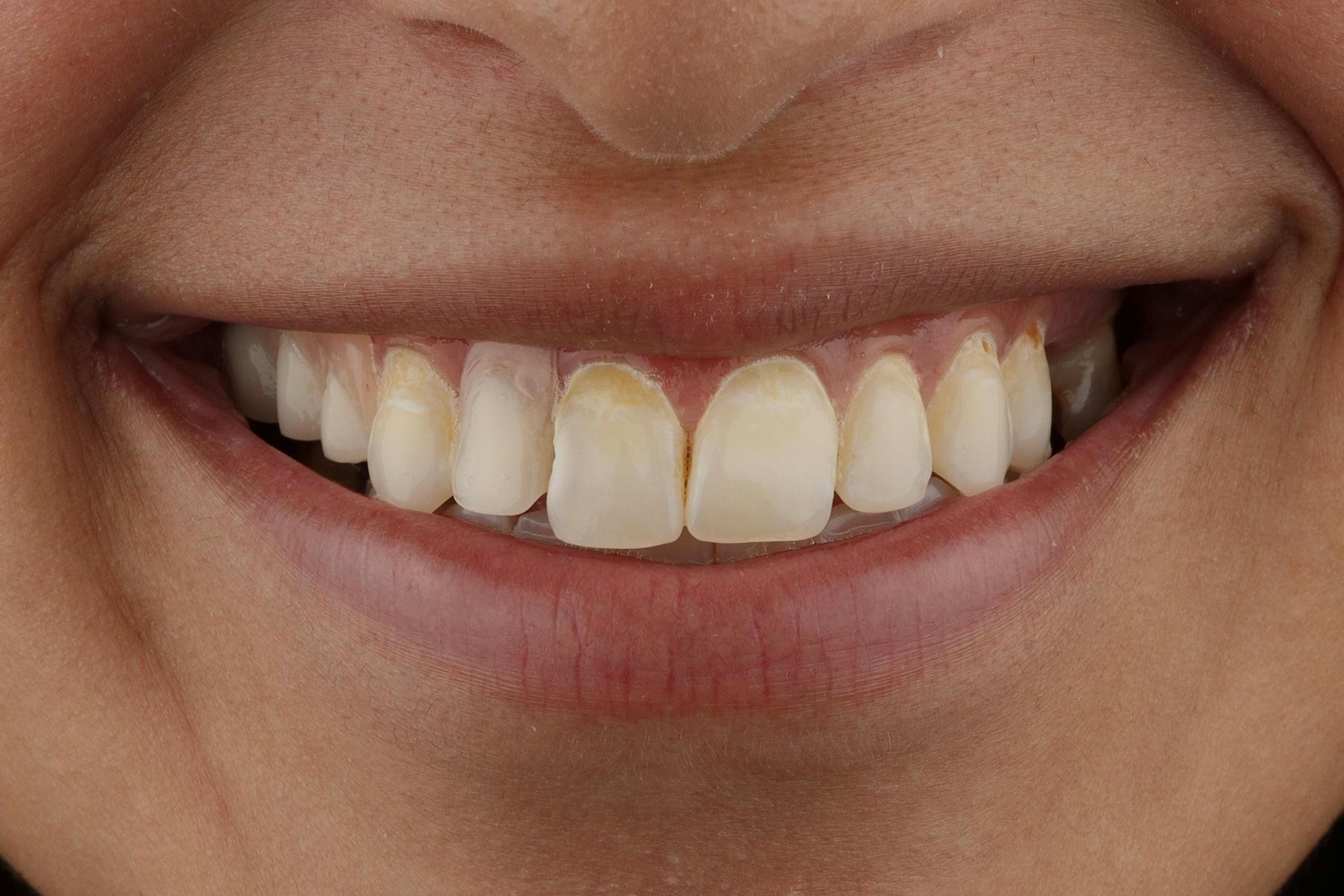 dental implants patient before