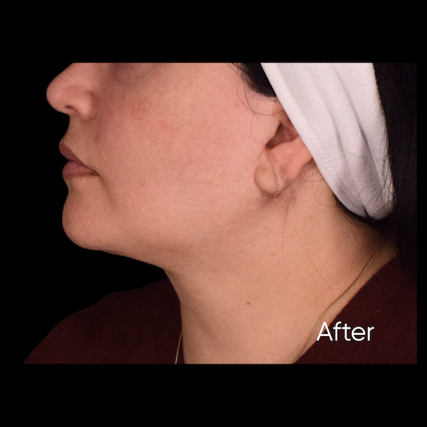 facelift before & after photo
