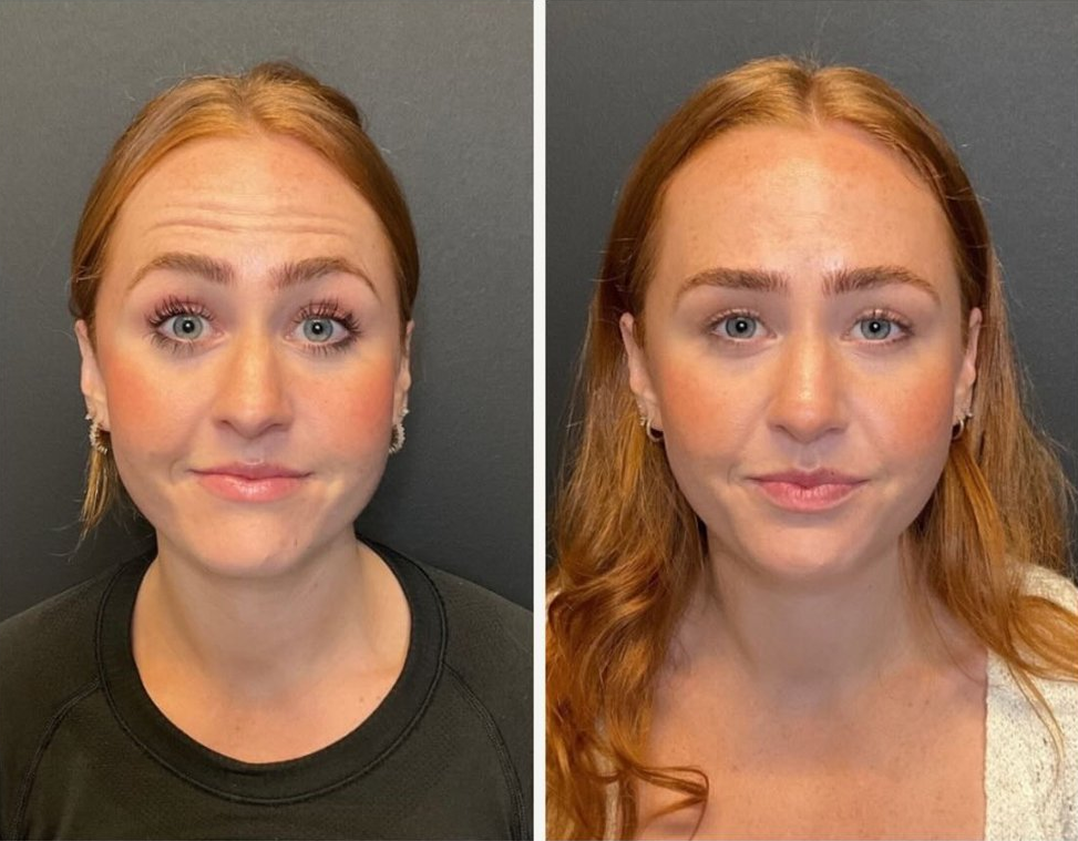 Xeomin botox patient before & after