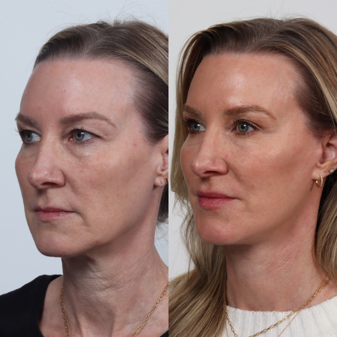 facelift patient #1 before and after
