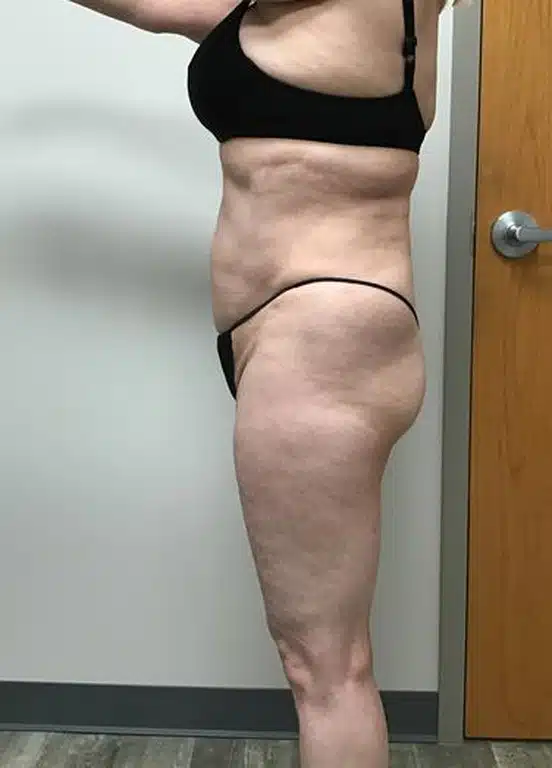 liposuction before & after patient #1