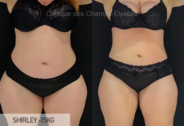 Avant/Apr&egrave;s traitement capillaire