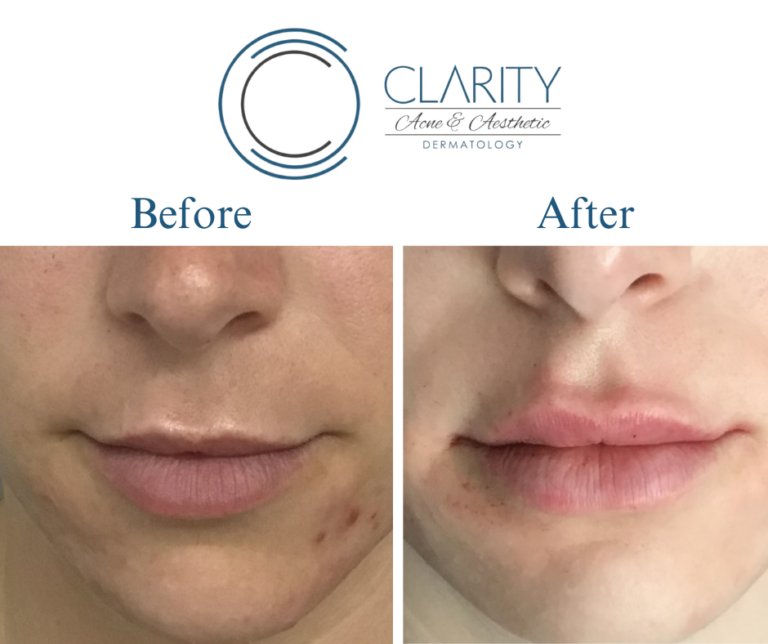 lip fillers before & after