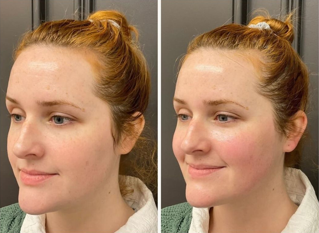 Hydrafacial patient before & after