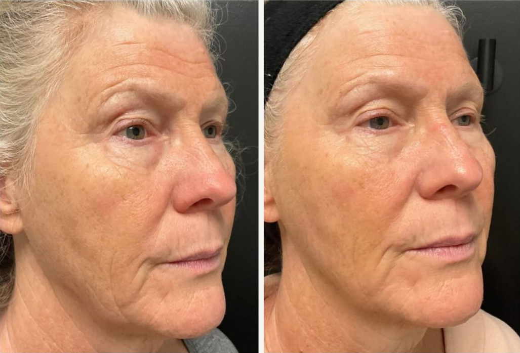 Microneedling combination treatment patient before & after