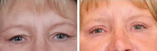 patient 3 eyelid lift before and after