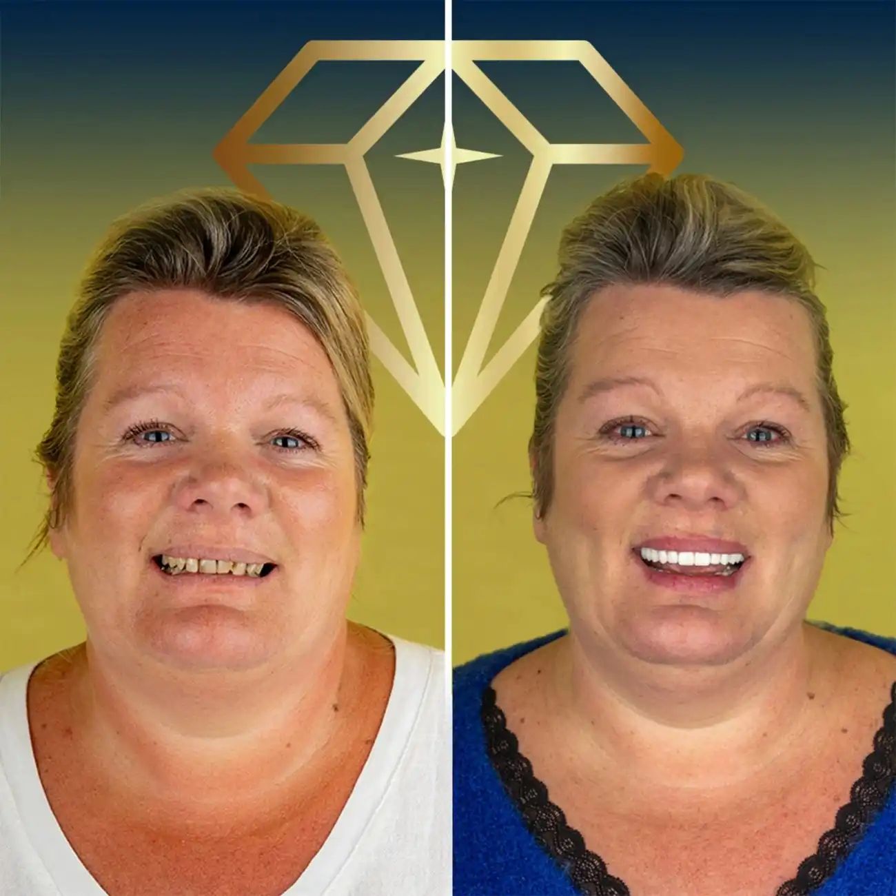 alt="Before and after dental implants transformation at Kristal Clinic"
