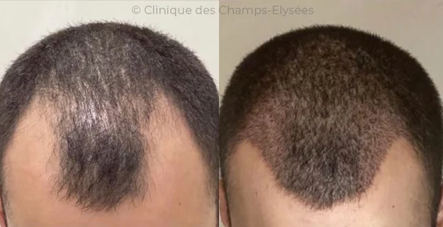 Avant/Après traitement capillaire