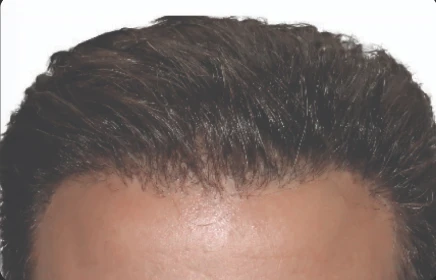 hair restoration