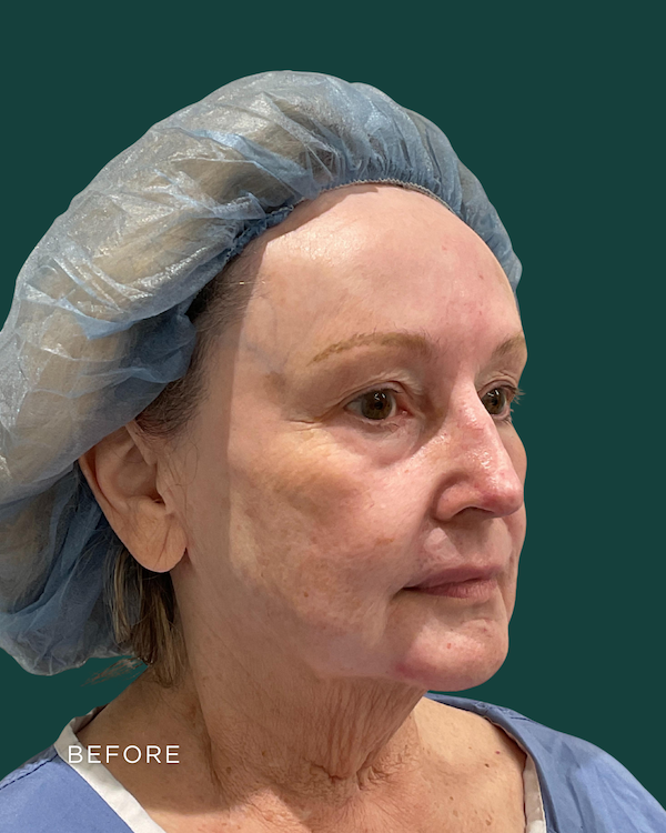 facelift before & after photo