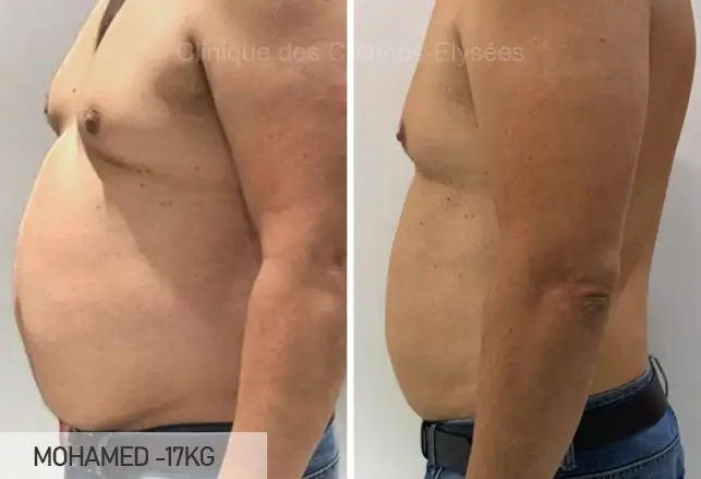 Avant/Apr&egrave;s traitement capillaire