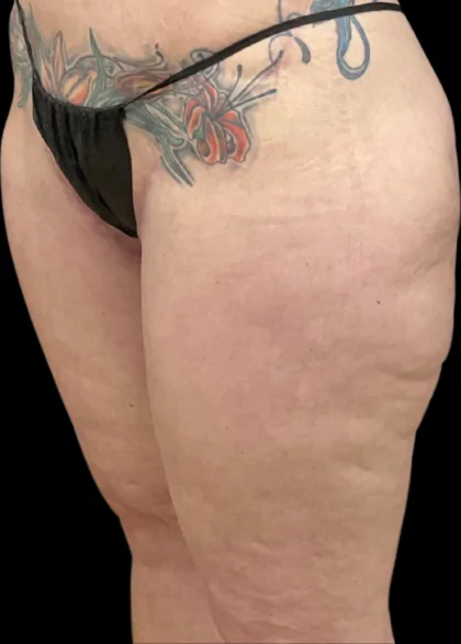 body lift after