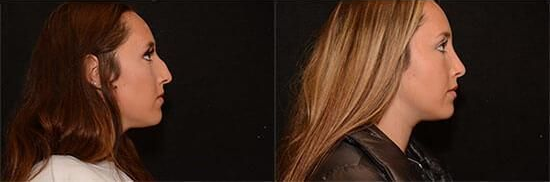 rhinoplasty before and after patient 6