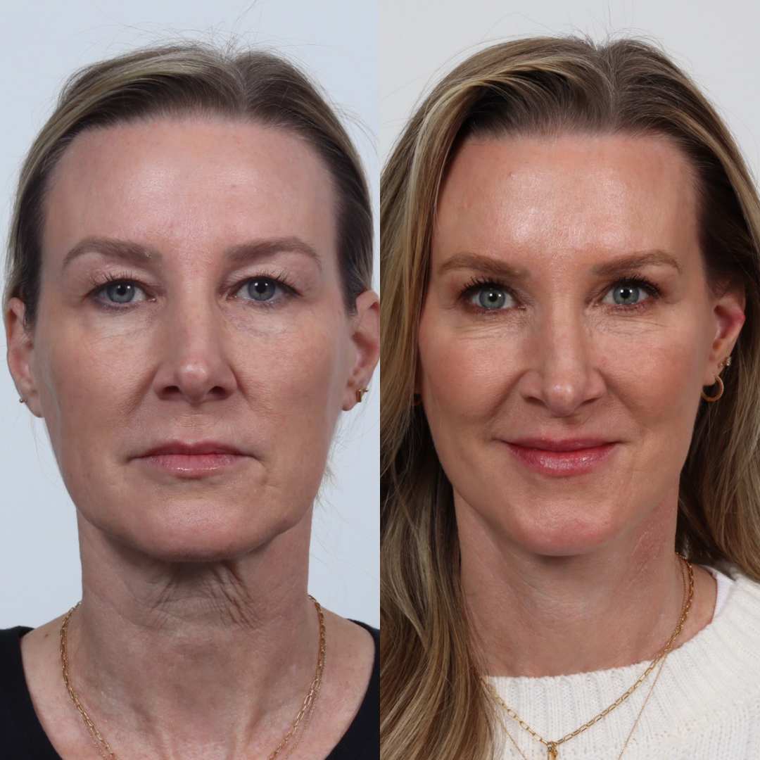 facelift patient #1 before and after