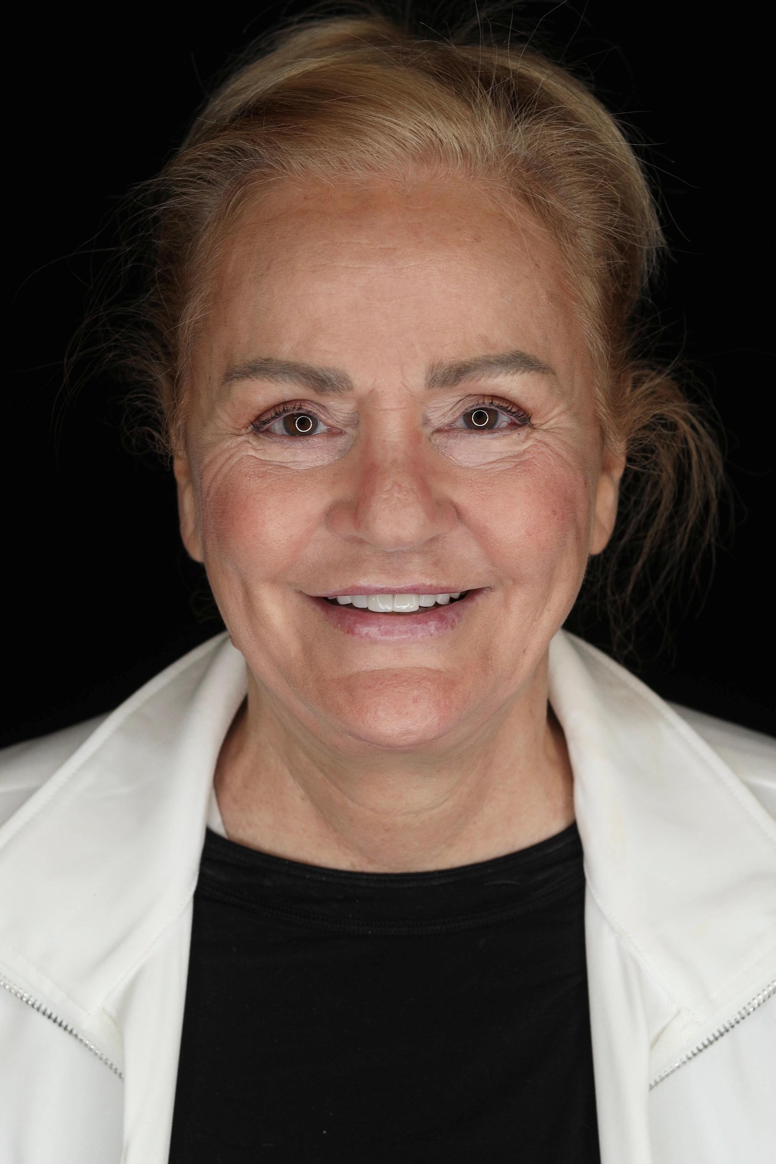 dental implants patient before