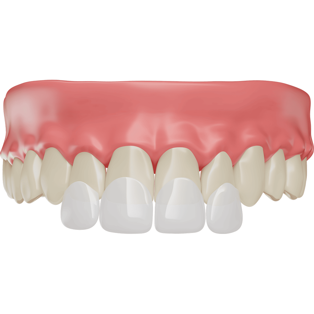 Veneers