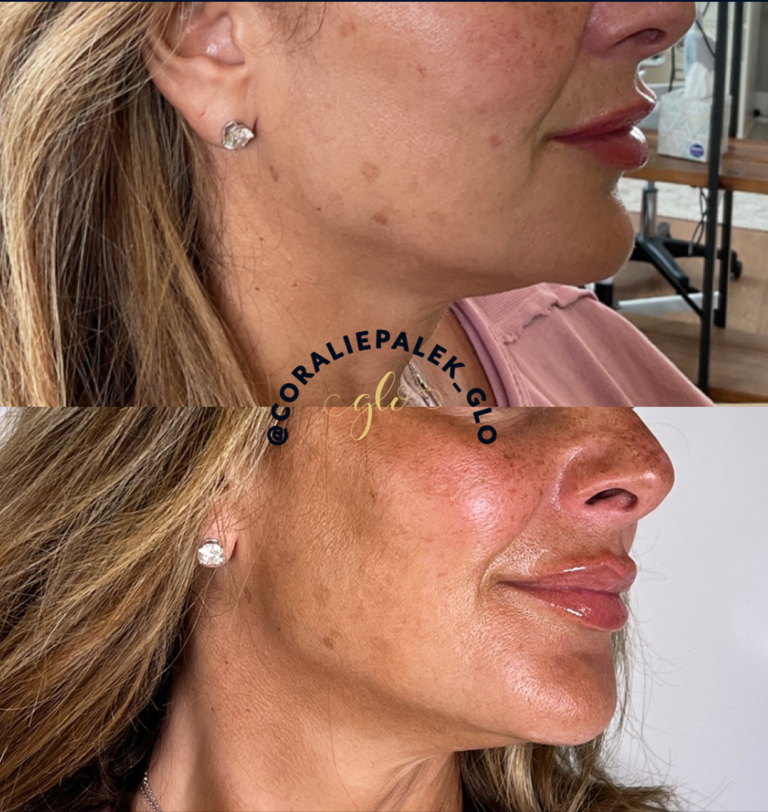 fillers before and after