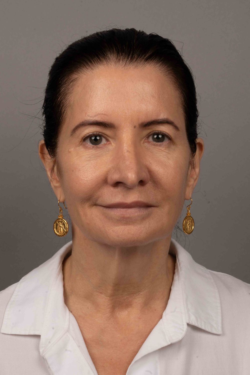 face/neck patient before & After