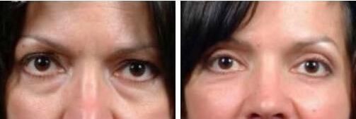 blepharoplasty patient 5 before and after
