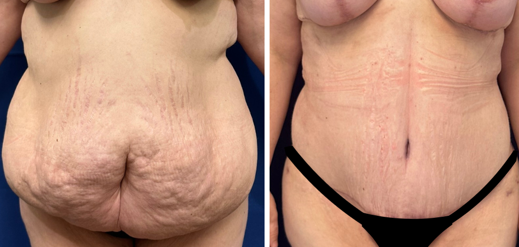 tummy tuck surgery patient 5 before & after