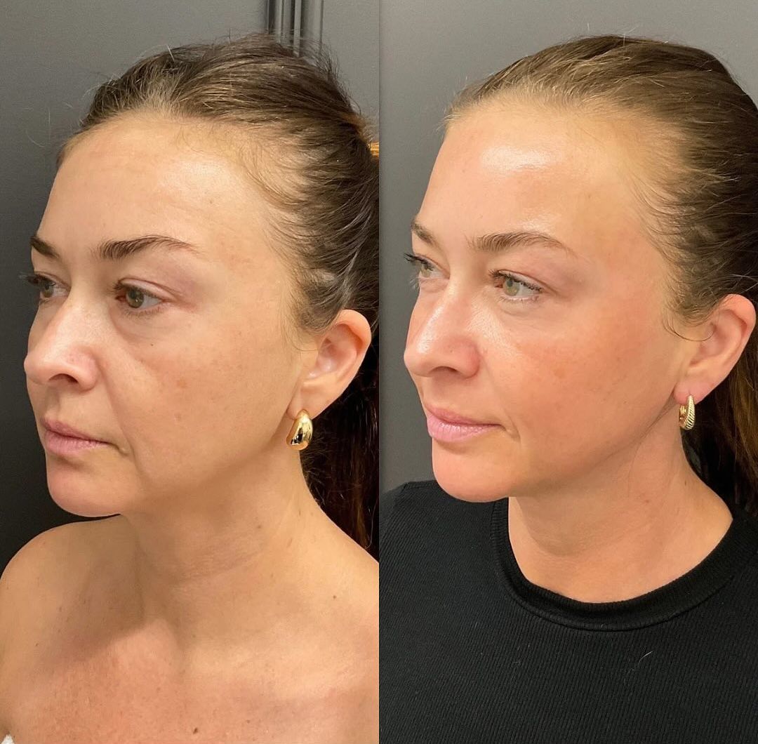 morpheus8 patient 1 before and after