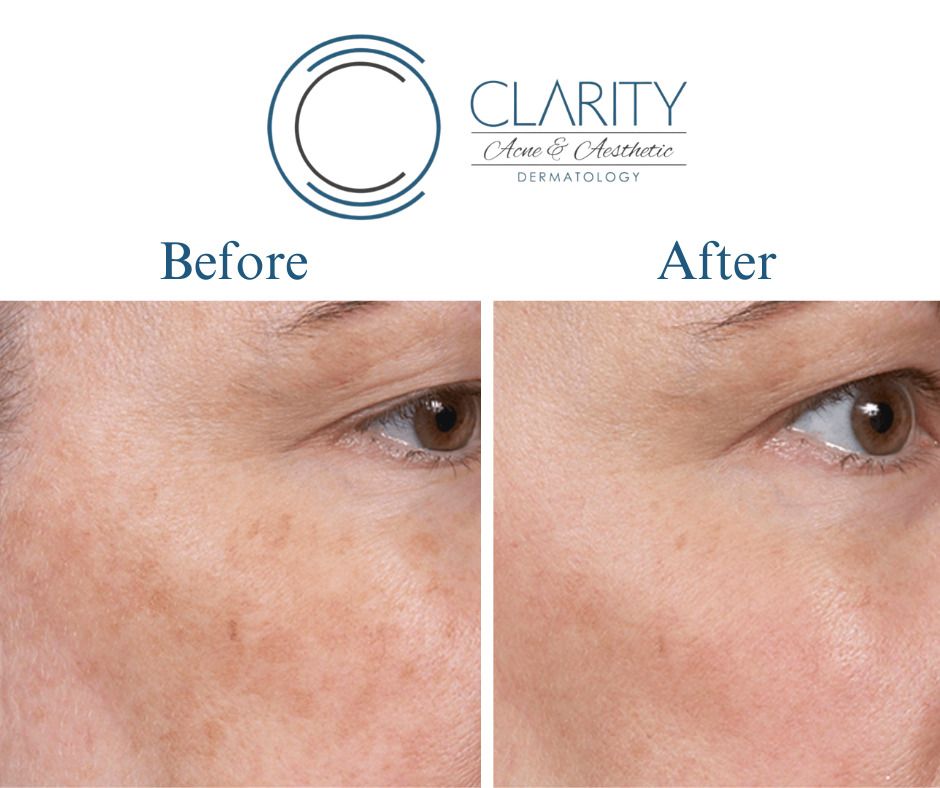 before and after results