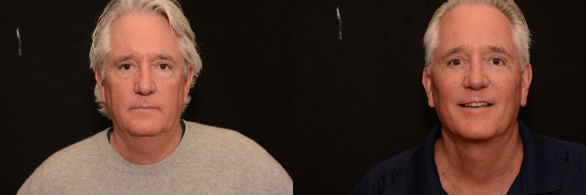 male patient 1 facelift before and after
