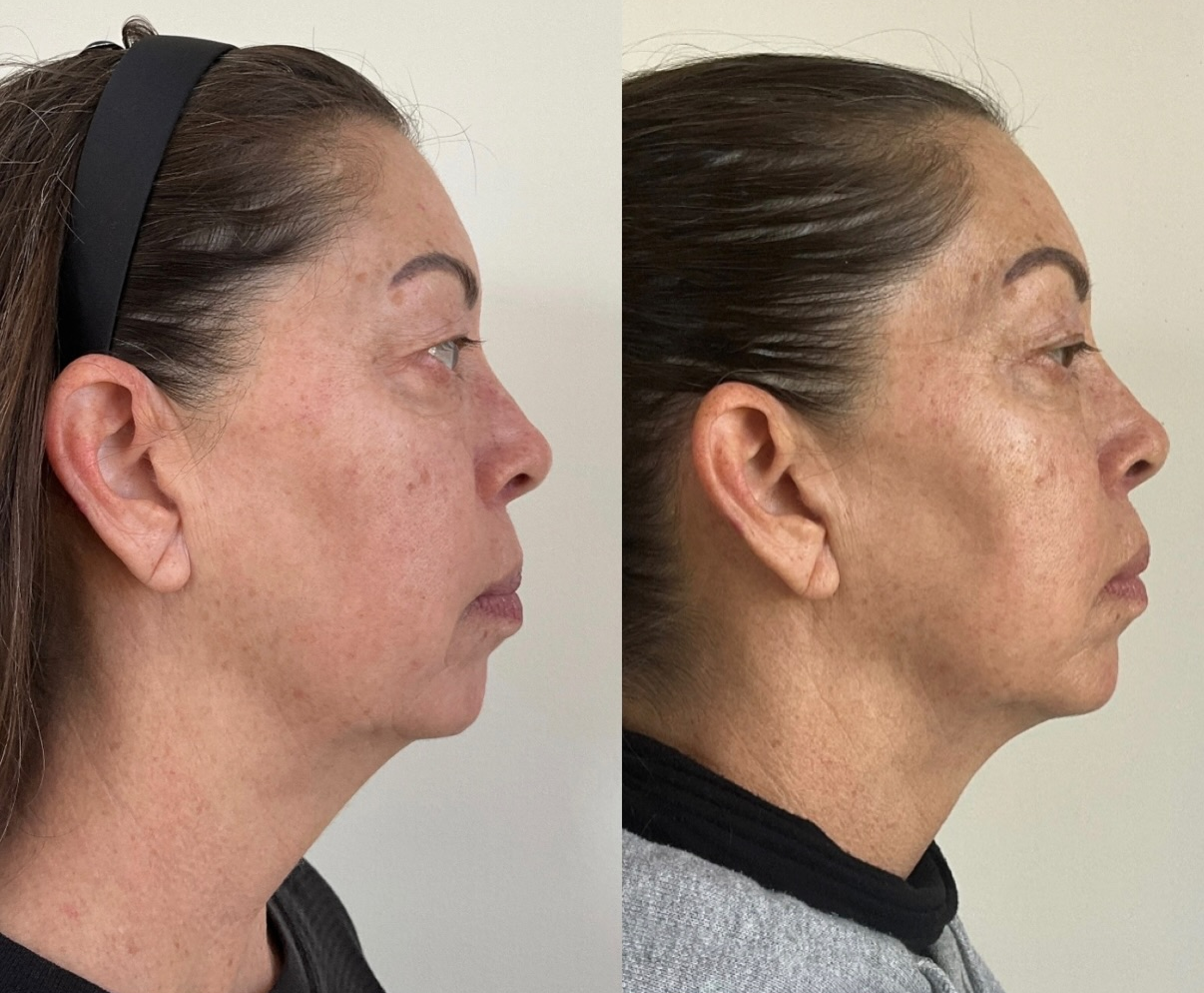 AccuTite patient before & after