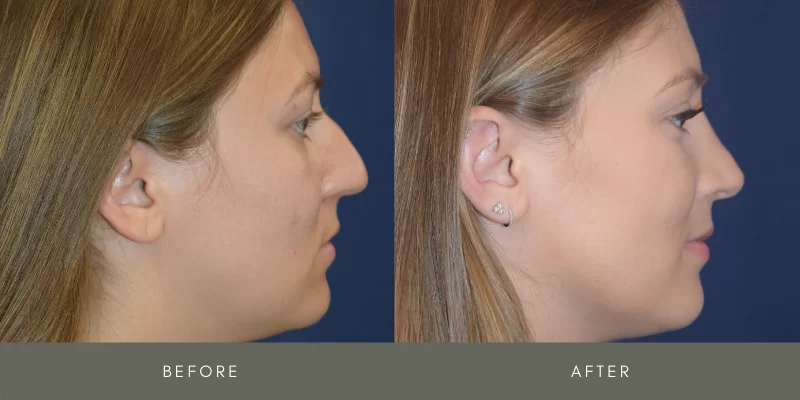 rhinoplasty before & after