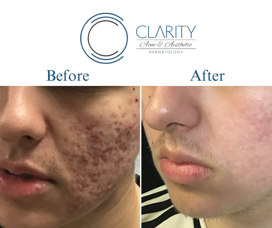 microneedling before & after
