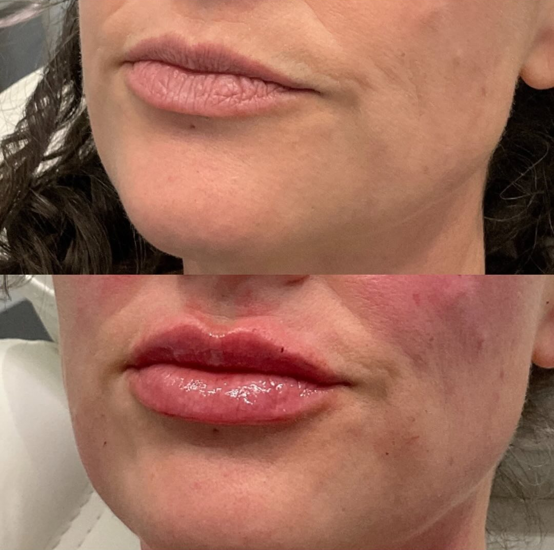 lip enhancement patient 2 before & after