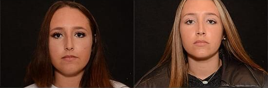 rhinoplasty before and after patient 6