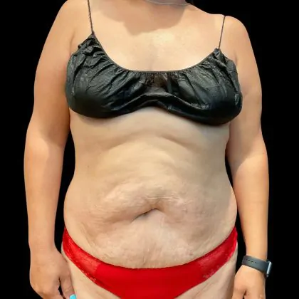 body lift before