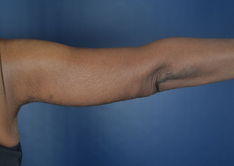 arm lift after photo