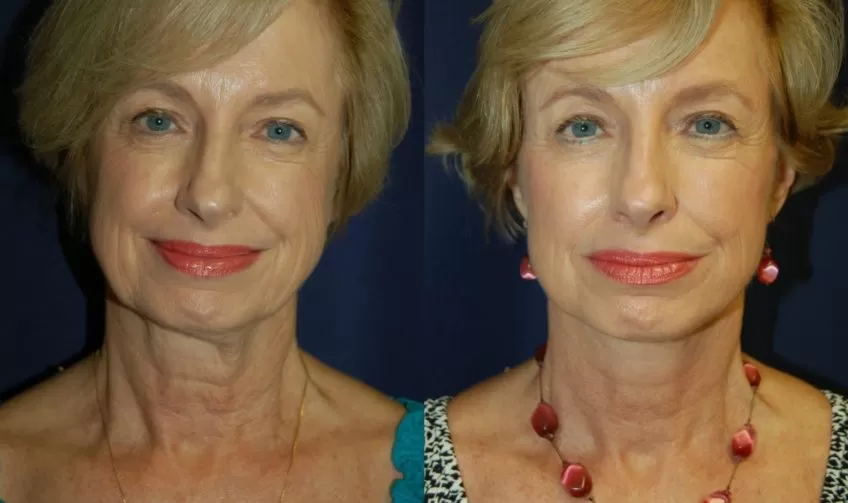 facelift and neck lift before & after
