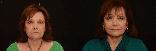 female patient 2 facelift surgery before and after