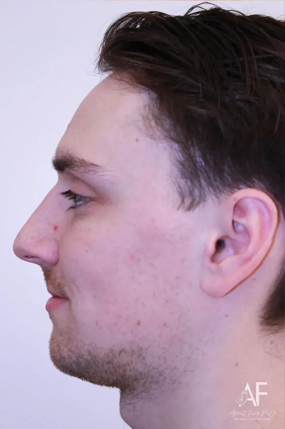 rhinoplasty before and after