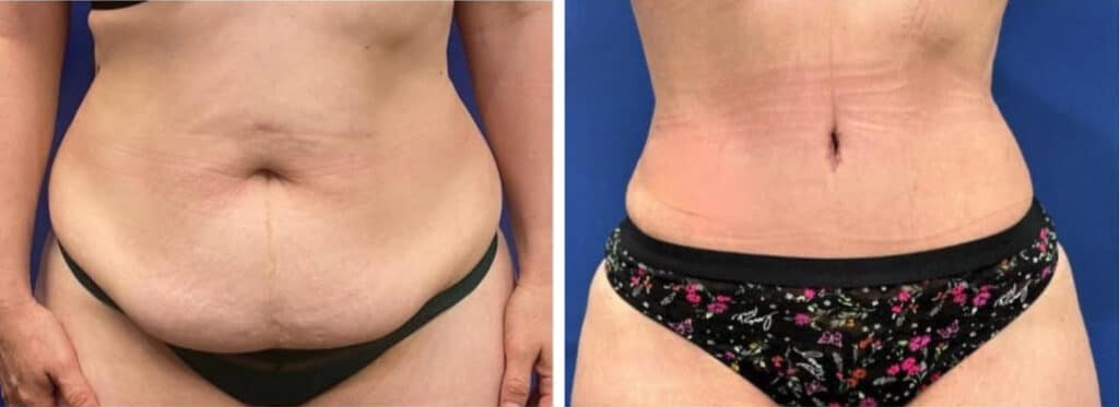 tummy tuck patient 1 before & after