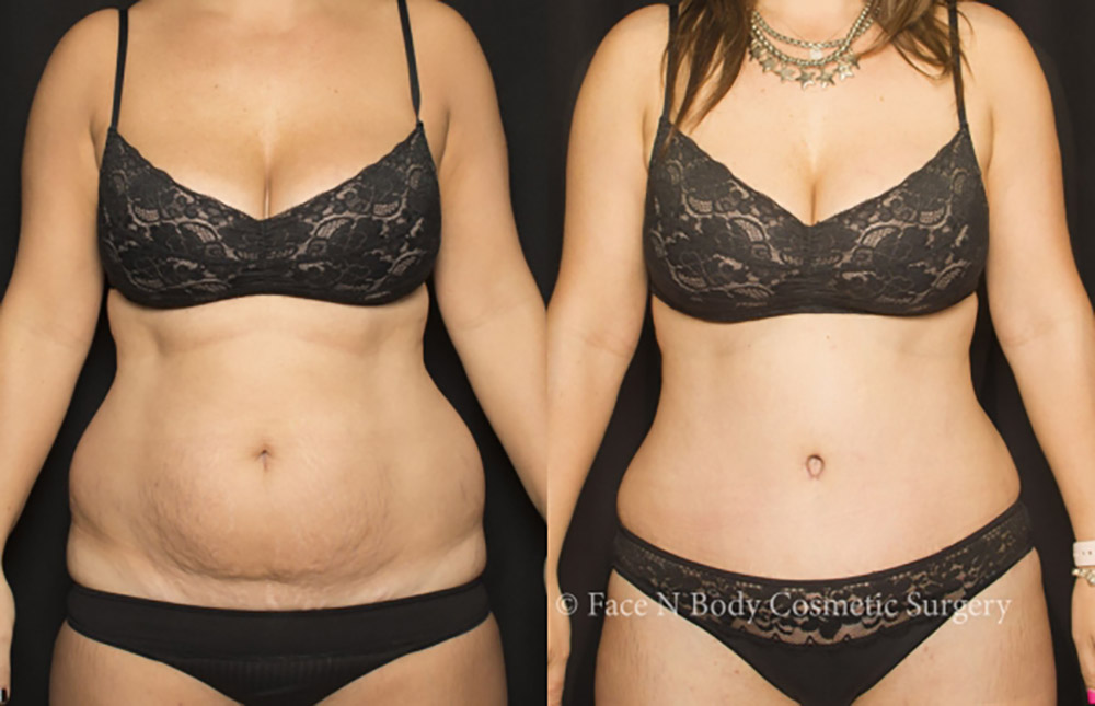 liposuction before and after
