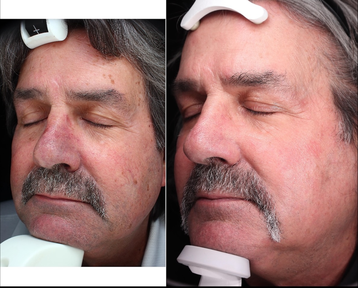 bbl before and after