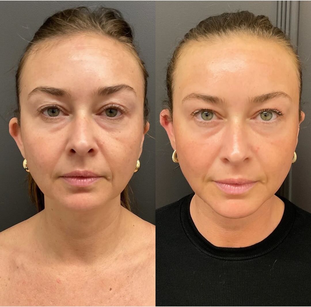 morpheus8 patient 1 before and after