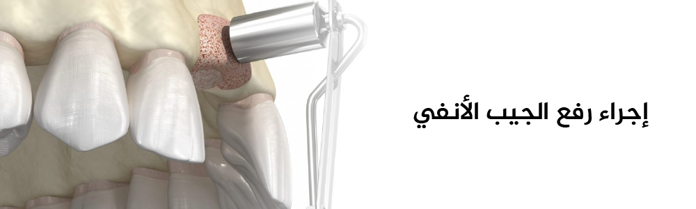 إجراء رفع الجيوب الانفية