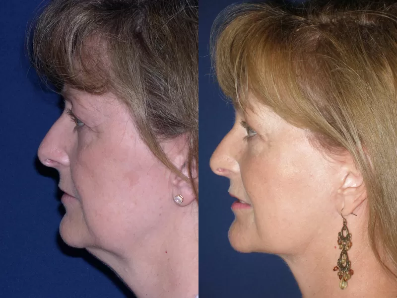 facelift and neck lift before & after