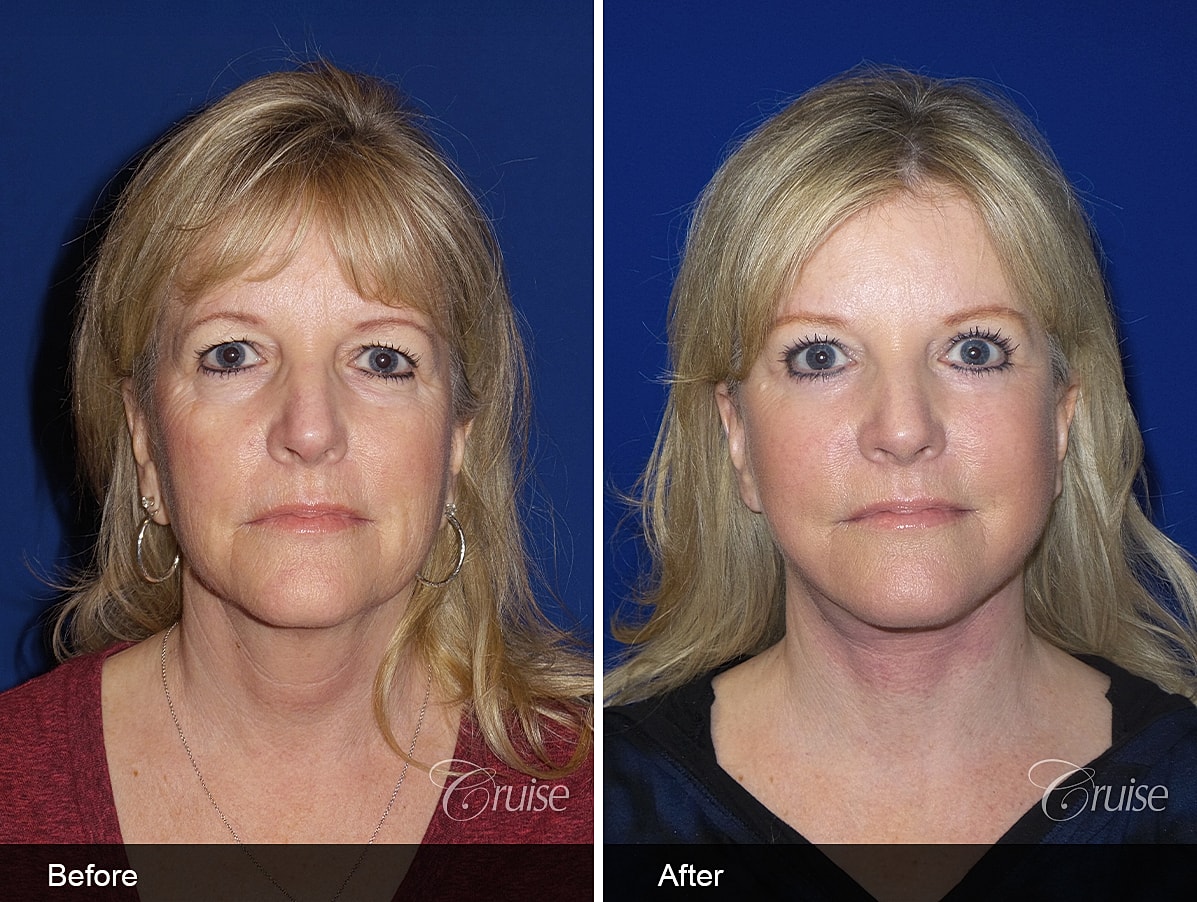 facelift before and after