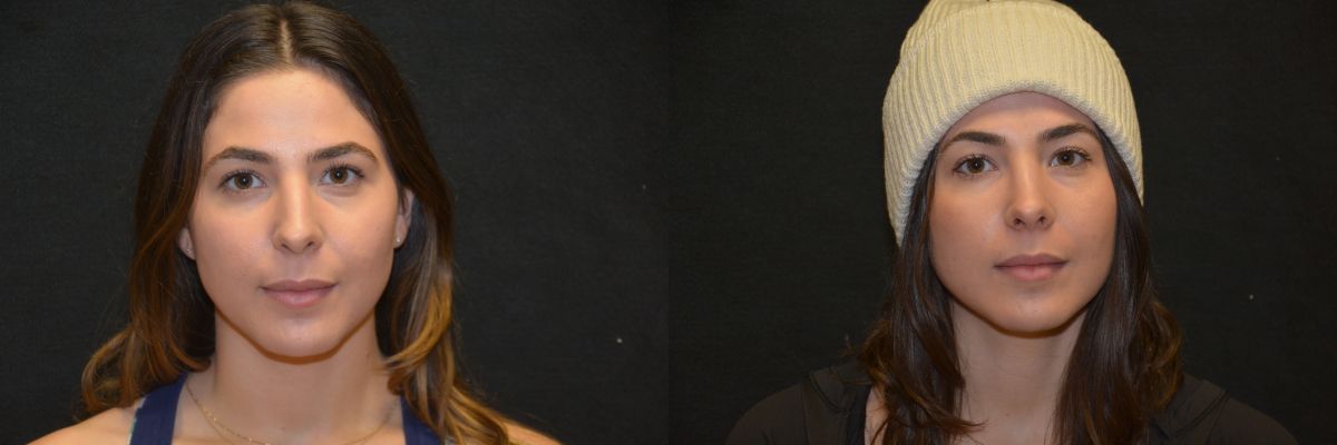 cosmetic nose surgery before and after patient 3